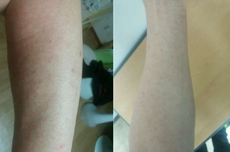 21일 오전 지카바이러스 환자의 발진 상태(왼쪽)와 22일 발진 상태(오른쪽). 21일 오전에 비해 발진이 감소했고 상태도 호전되고 있다.  질병관리본부 제공